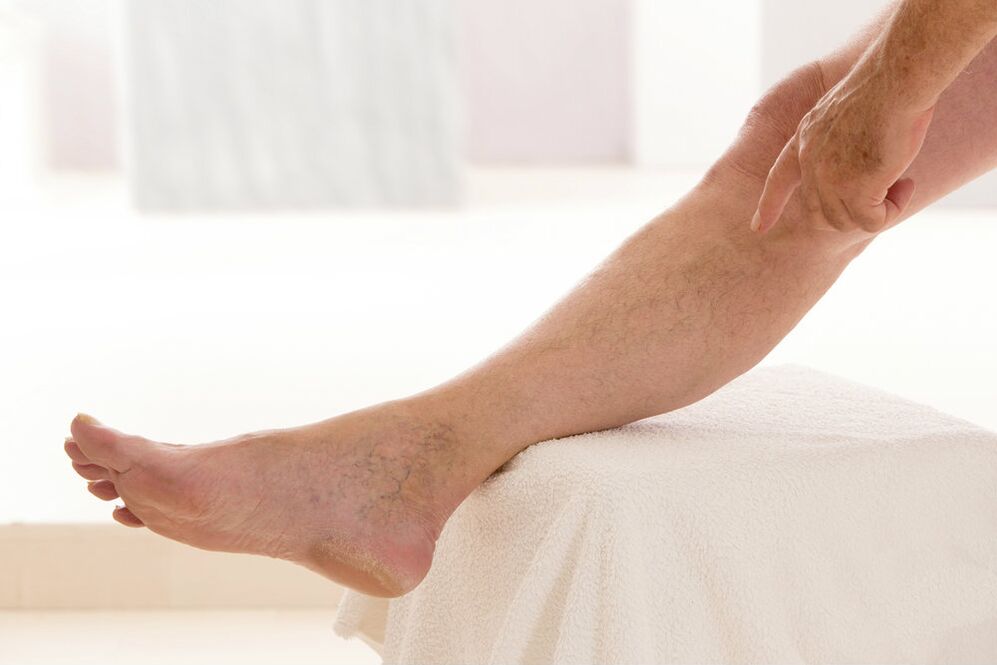 Varices nas pernas