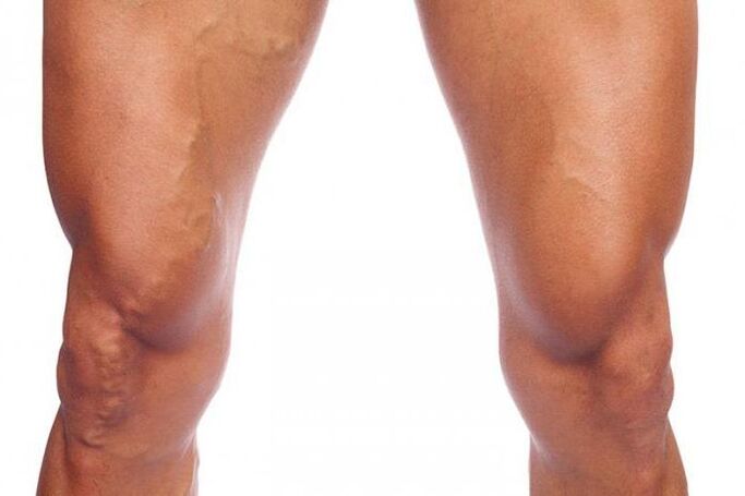 Varices